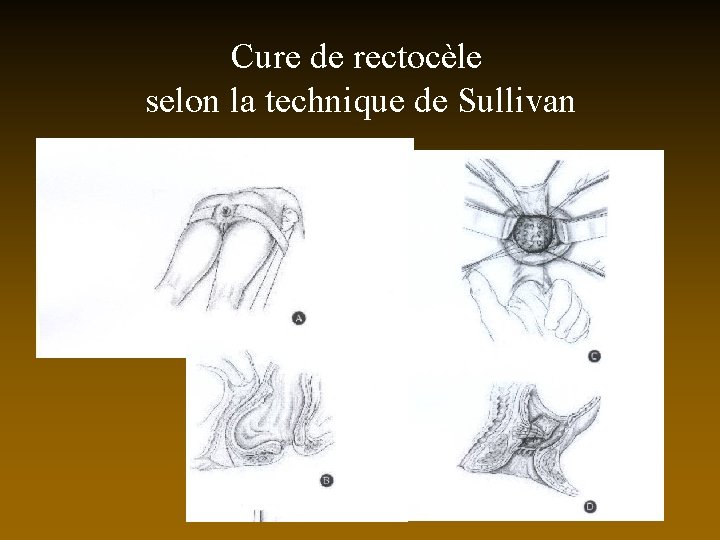 Cure de rectocèle selon la technique de Sullivan 