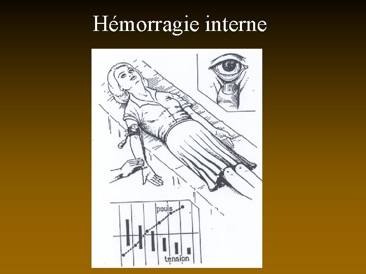 Hémorragie interne 