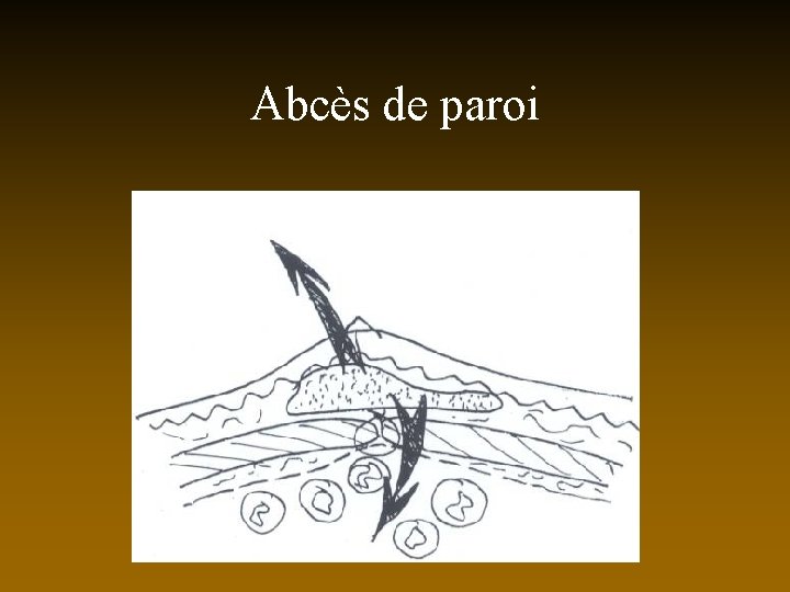 Abcès de paroi 