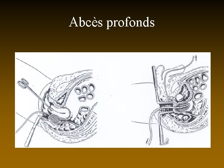 Abcès profonds 