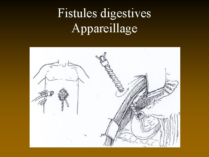 Fistules digestives Appareillage 