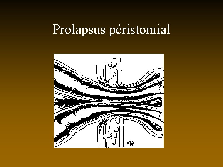 Prolapsus péristomial 