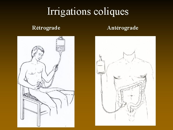 Irrigations coliques Rétrograde Antérograde 