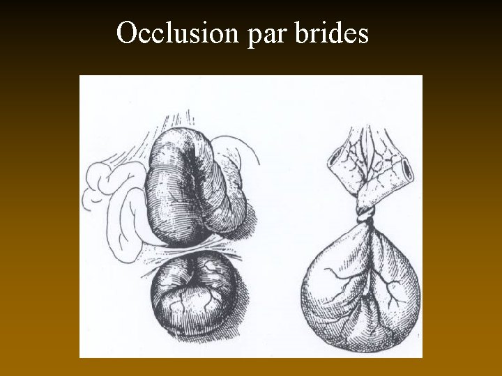 Occlusion par brides 