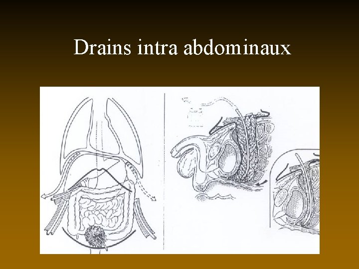 Drains intra abdominaux 