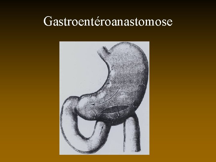 Gastroentéroanastomose 