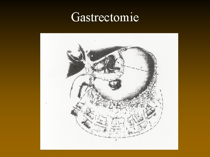 Gastrectomie 