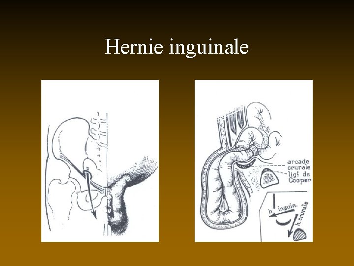 Hernie inguinale 