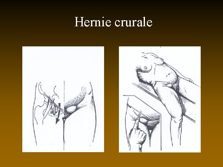 Hernie crurale 