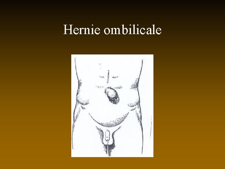 Hernie ombilicale 