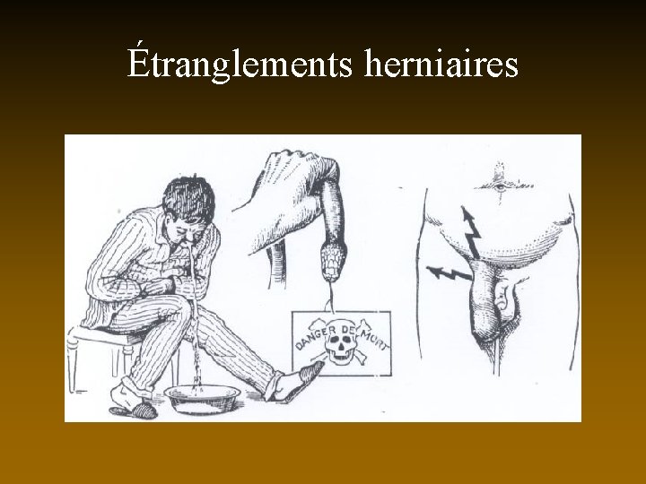 Étranglements herniaires 