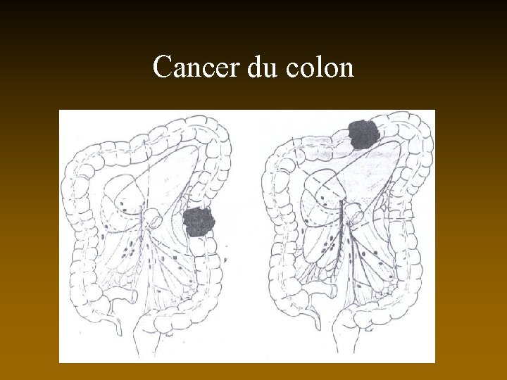 Cancer du colon 