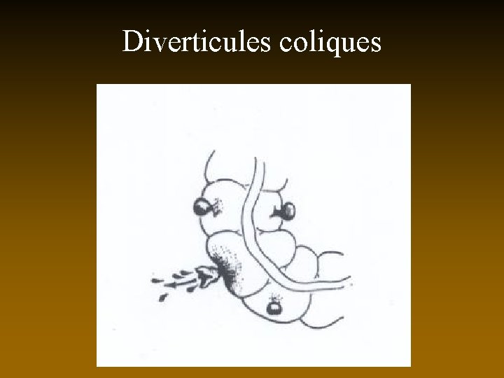 Diverticules coliques 