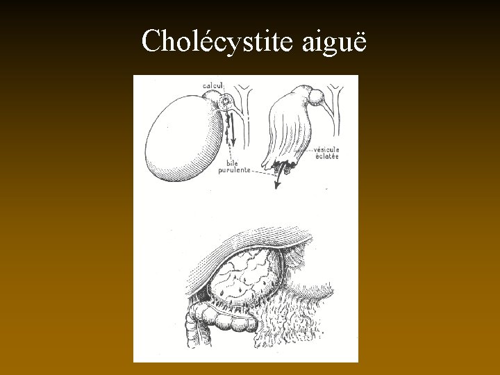 Cholécystite aiguë 