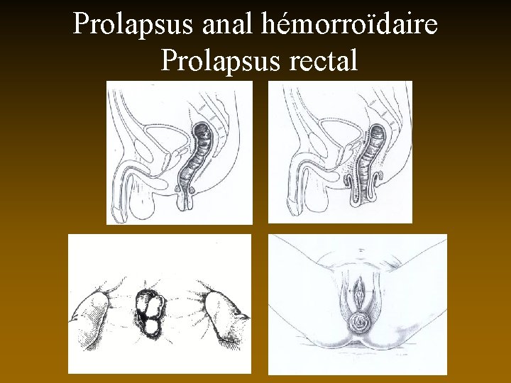 Prolapsus anal hémorroïdaire Prolapsus rectal 
