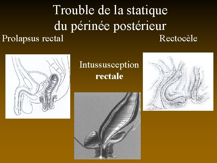 Trouble de la statique du périnée postérieur Rectocèle Prolapsus rectal Intussusception rectale 