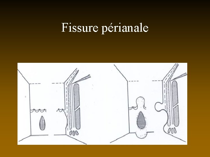 Fissure périanale 