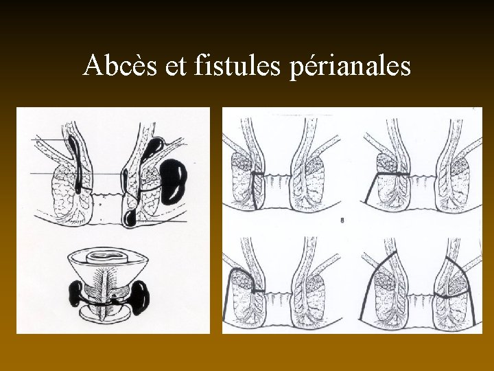 Abcès et fistules périanales 