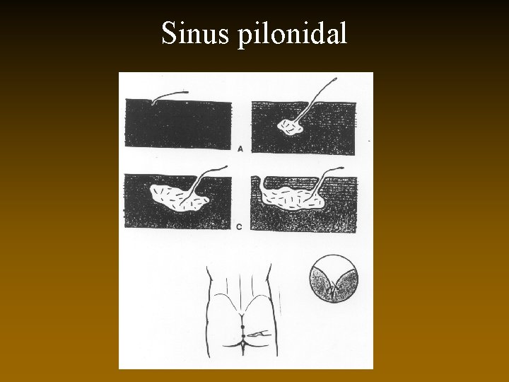 Sinus pilonidal 