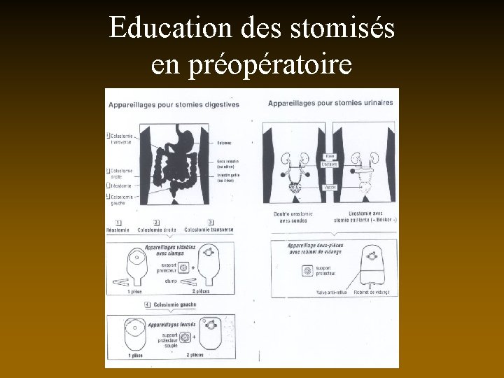 Education des stomisés en préopératoire 