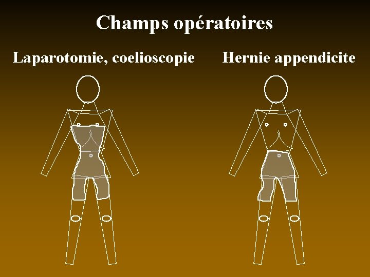 Champs opératoires Laparotomie, coelioscopie Hernie appendicite 