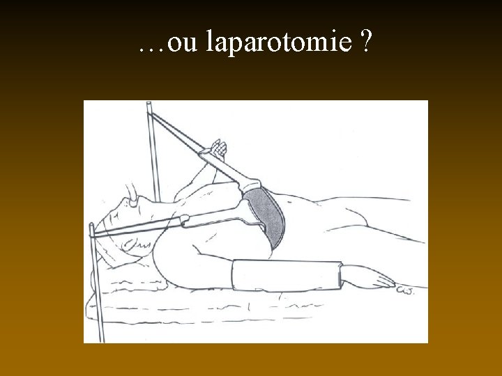 …ou laparotomie ? 