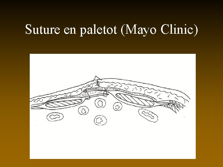 Suture en paletot (Mayo Clinic) 