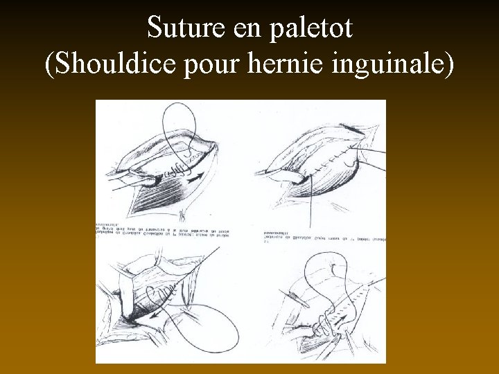 Suture en paletot (Shouldice pour hernie inguinale) 