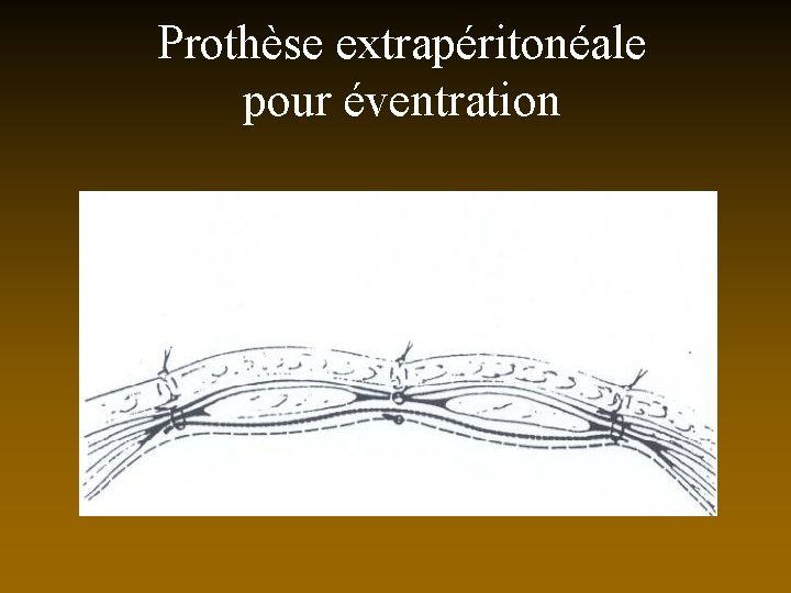 Prothèse extrapéritonéale pour éventration 
