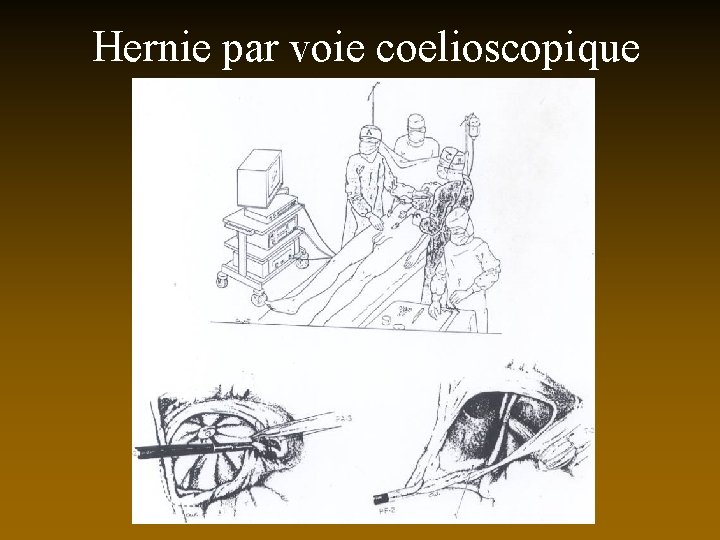 Hernie par voie coelioscopique 