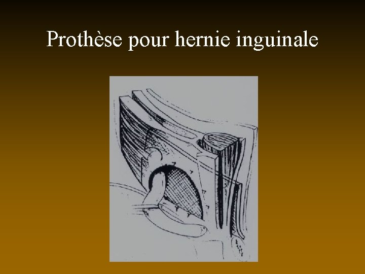Prothèse pour hernie inguinale 