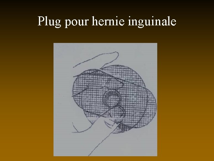 Plug pour hernie inguinale 