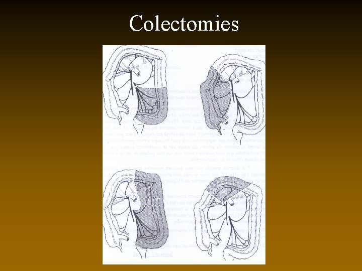 Colectomies 