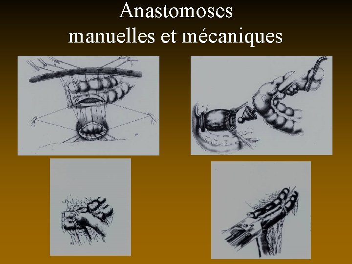 Anastomoses manuelles et mécaniques 