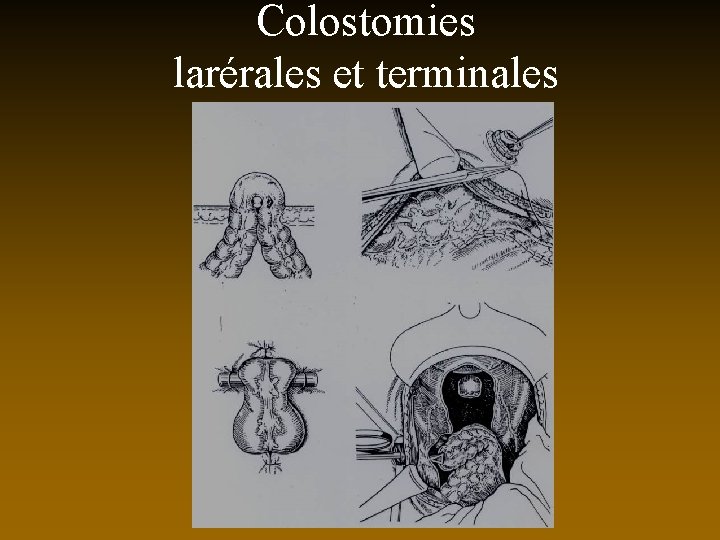 Colostomies larérales et terminales 