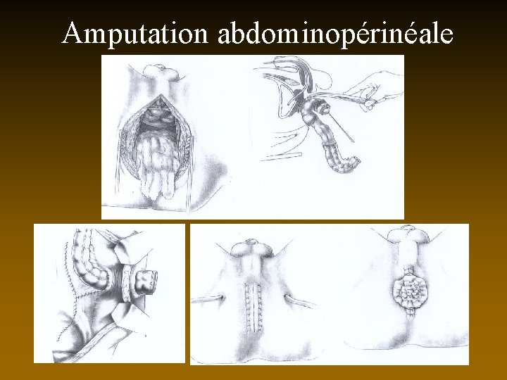 Amputation abdominopérinéale 