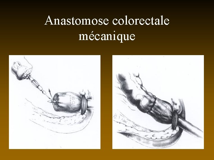 Anastomose colorectale mécanique 