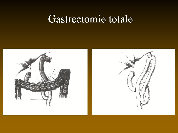 Gastrectomie totale 