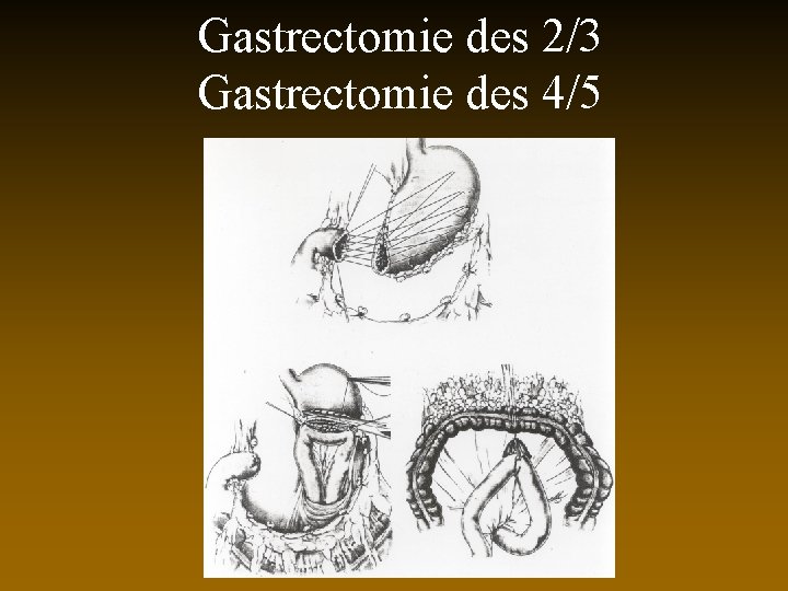 Gastrectomie des 2/3 Gastrectomie des 4/5 