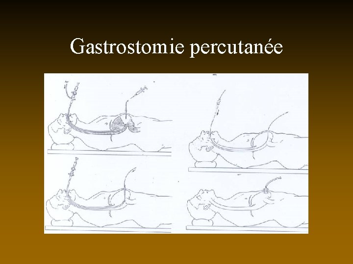 Gastrostomie percutanée 