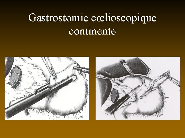 Gastrostomie cœlioscopique continente 