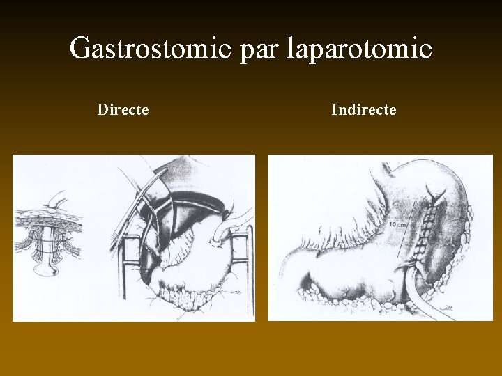 Gastrostomie par laparotomie Directe Indirecte 