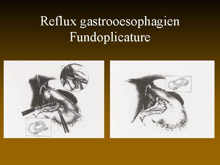 Reflux gastrooesophagien Fundoplicature 