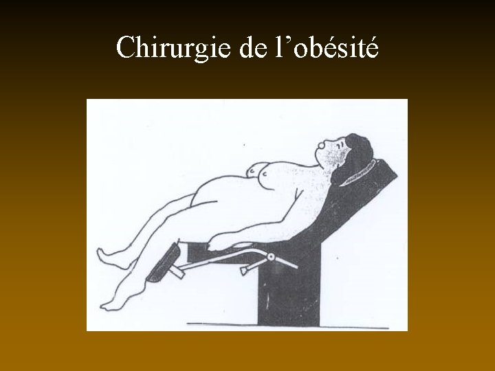 Chirurgie de l’obésité 