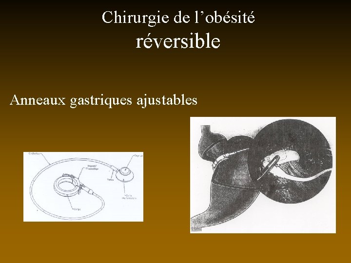 Chirurgie de l’obésité réversible Anneaux gastriques ajustables 