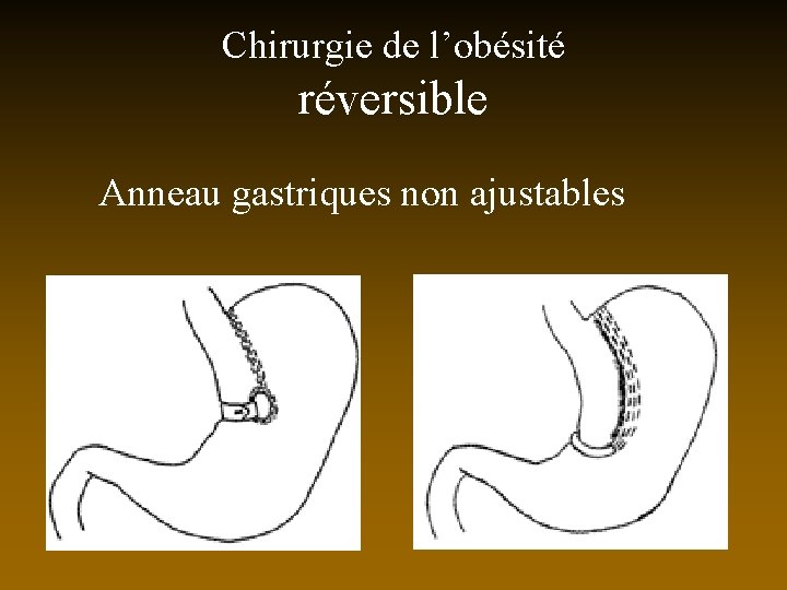 Chirurgie de l’obésité réversible Anneau gastriques non ajustables 