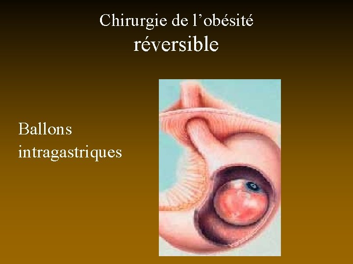 Chirurgie de l’obésité réversible Ballons intragastriques 
