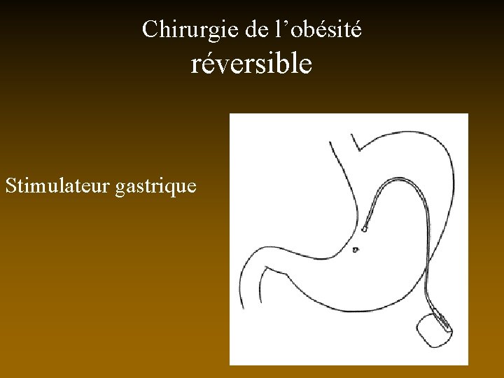 Chirurgie de l’obésité réversible Stimulateur gastrique 