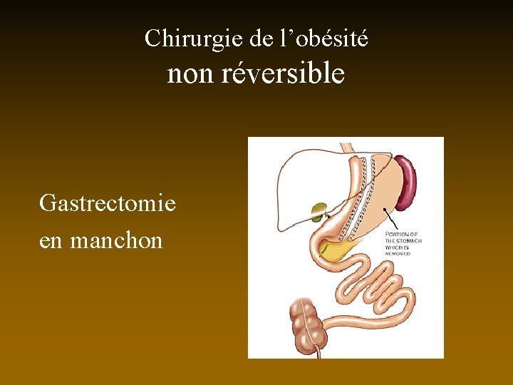 Chirurgie de l’obésité non réversible Gastrectomie en manchon 