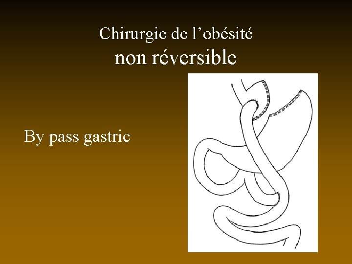 Chirurgie de l’obésité non réversible By pass gastric 